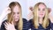 Before and after. The girl looks in front of the mirror at her oily hair. Problematic scalp and increased secretion of the