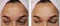 Girl pimples on the forehead before and after procedures