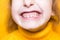 Girl shows her teeth-pathological bite, malocclusion, overbite. Pediatric dentistry and periodontics, bite correction. Health and