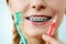 Girl with teeth braces using interdental and traditional brush