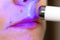 Girl treats inflamed red acne on the skin of the face with a laser cosmetic pen, cosmetic procedure. Macro