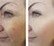 Girl wrinkles aging before and after the procedures