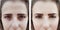 Girl wrinkles eyes before after procedures bags