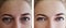 Girl wrinkles eyes before and after treatments removal