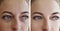 Girl wrinkles eyes before and after treatments removal bags