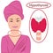 Goiter. Enlarged Thyroid. Endocrine disfunction vector illustration