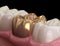 Golden crown molar tooth assembly process. Medically accurate 3D illustration of human teeth