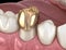 Golden crown premolar tooth assembly process. Medically accurate 3D illustration of human teeth