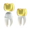 Golden Dental crowns and tooth