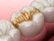 Golden Inlay crown fixation over tooth. Medically accurate 3D illustration of human teeth