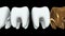Golden tooth in a row of the white teeth. 3D.