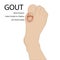 Gout arthritis. Human foot. Vector medical illustration.