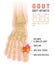 Gout arthritis infographic