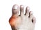 Gout of the big toe