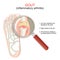 Gout. Close-up of joint with inflammatory arthritis