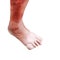 Gout disease at foot on white background