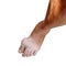 Gout disease at foot on white background