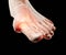 Gout inflammatory arthritis on human feet toe finger