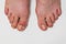 Gout or podagra on the big toe appears as redness and a unbearable pain