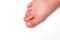 Gout or podagra on the big toe appears as redness and a unbearable pain