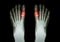 Gout , Rheumatoid arthritis ( Film x-ray both foot and arthritis at first metatarsophalangeal joint ) ( Medicine and Science