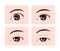 Grading in ptosis vector illustration