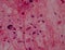 Gram stain showing blue cells gram positive in single,in pair,in cluster intracellular on red white blood cells background.Pus sp
