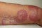 Granuloma annulare, a rare skin disease.