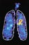 Graphic Image Showing Disease In Human Lung