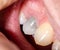 Gray darkened tooth after nerve removal and pulpitis disease. Lack of tooth nutrition, restoration and restoration of a