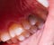 Gray darkened tooth after nerve removal and pulpitis disease. Lack of tooth nutrition, restoration and restoration of a dead tooth