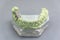 Green dental tooth implant plaster pattern with metal bridge on table