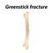 Greenstick fracture Bone. Infographics. Vector illustration on a lined background.