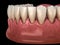 Gum recession process. Medically accurate 3D illustration