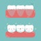 Gum surgery for nice teeth of dental