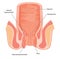 Haemorrhoids shown in cross section of anal canal