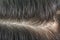 Hair dandruff Dandruff and scalp