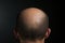 Hair health Adult male coping with baldness, alopecia, and hairline