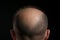 Hair health Adult male coping with baldness, alopecia, and hairline