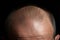 Hair health Adult male coping with baldness, alopecia, and hairline