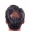 Hair loss and grey hair, Male head with hair loss symptoms back