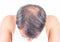 Hair loss and grey hair, Male head with hair loss symptoms front