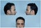 Hair loss or  Receding hairline in man