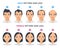Hair loss stages, androgenetic alopecia male and female pattern