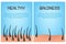 Hair loss stages set of before and after steps. Side view of a man losing hair before and after hair treatment and