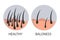 Hair loss stages set of before and after steps. Side view of a man losing hair before and after hair treatment and