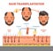 Hair Transplantation procedure diagram with steps