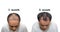 Hair transplantation surgery steps. Patient before and after the procedure