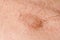 Hairy skin tag mole