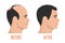 Hait transplantation before and after vector isolated